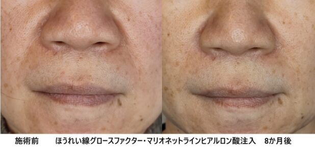 50代女性 症例16のほうれい線治療写真