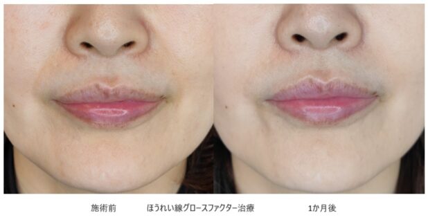 50代女性 症例17のほうれい線治療写真