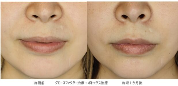 30代女性 症例14のほうれい線治療写真