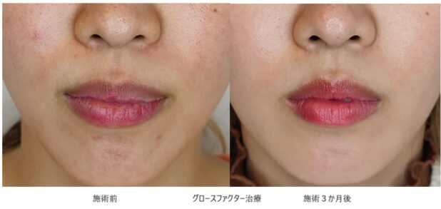 20代女性 症例8のほうれい線治療写真