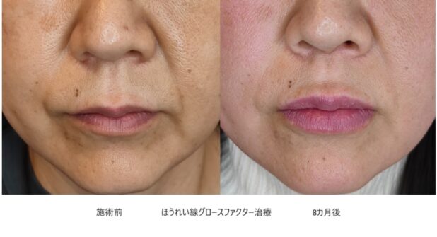 50代女性 症例15のほうれい線治療写真
