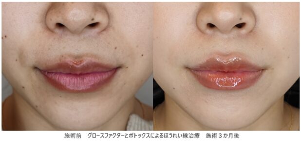 30代女性 症例15のほうれい線治療写真