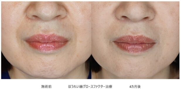 50代女性 症例20のほうれい線治療写真