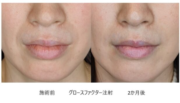 30代女性 症例17のほうれい線治療写真