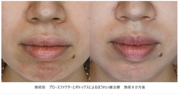 30代女性 症例18のほうれい線治療写真