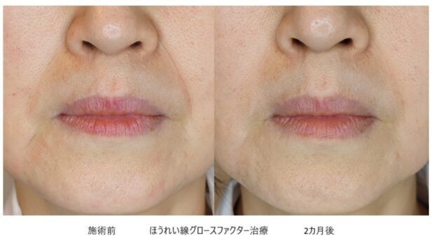 50代女性 症例23のほうれい線治療写真