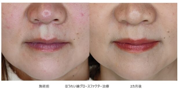 50代女性 症例22のほうれい線治療写真