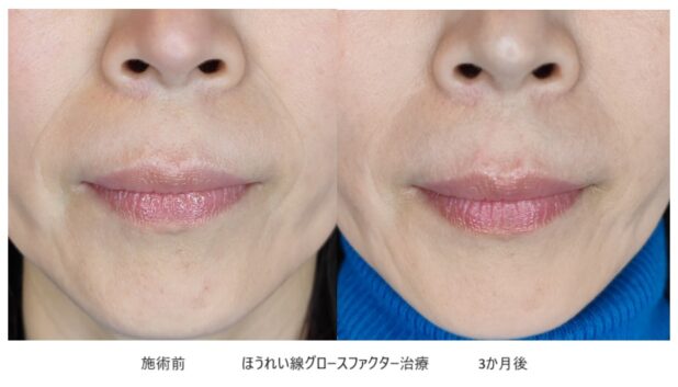 50代女性 症例21のほうれい線治療写真