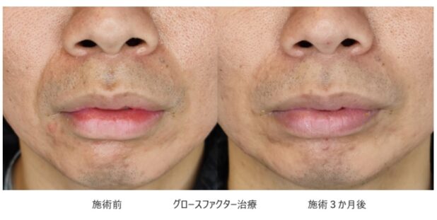20代男性 症例2のほうれい線治療写真