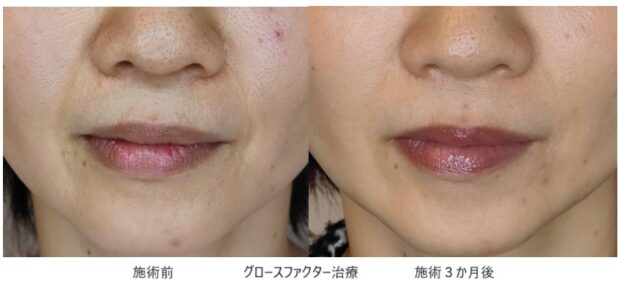 40代女性 症例17のほうれい線治療写真
