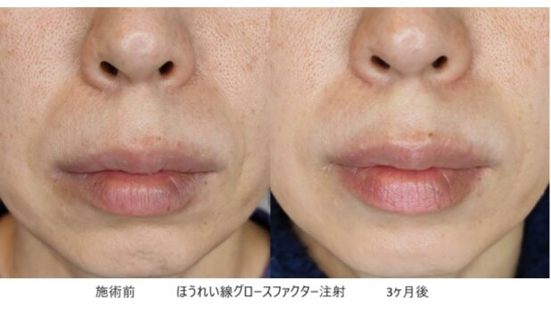40代女性 症例18のほうれい線治療写真