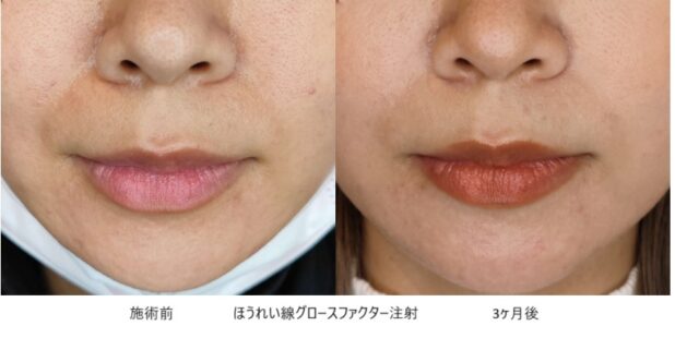 30代女性 症例21のほうれい線治療写真