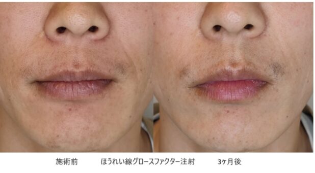 40代男性 症例3のほうれい線治療写真