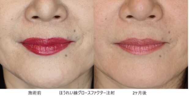 50代女性 症例26のほうれい線治療写真