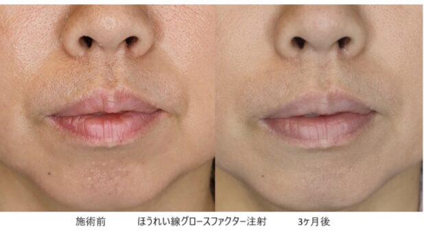 40代女性 症例19のほうれい線治療写真