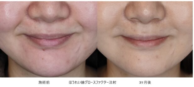 30代女性 症例22のほうれい線治療写真