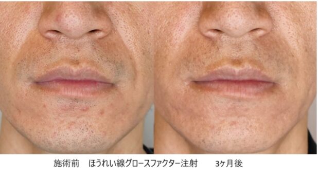 30代男性 症例4のほうれい線治療写真
