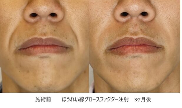 30代男性 症例3のほうれい線治療写真