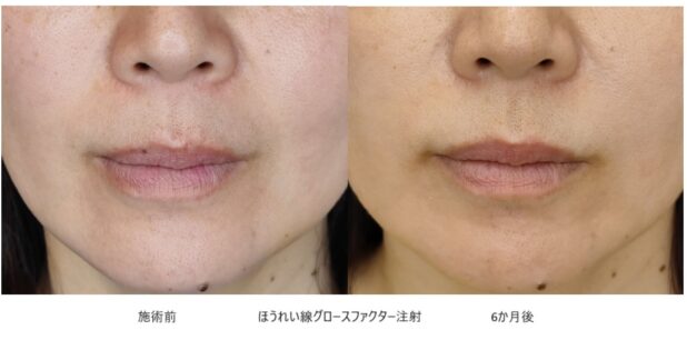40代女性 症例25のほうれい線治療写真