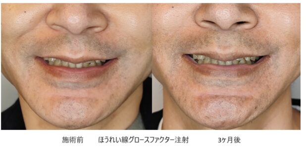 40代男性 症例4のほうれい線治療写真