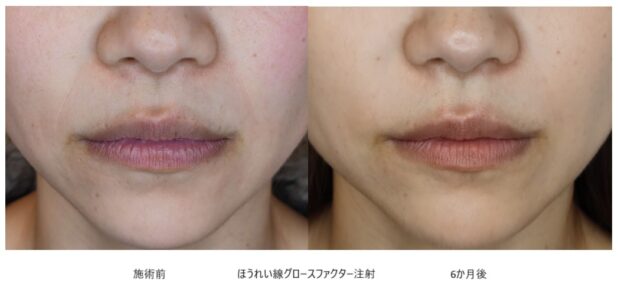 40代女性 症例21のほうれい線治療写真
