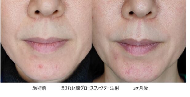 40代女性 症例23のほうれい線治療写真
