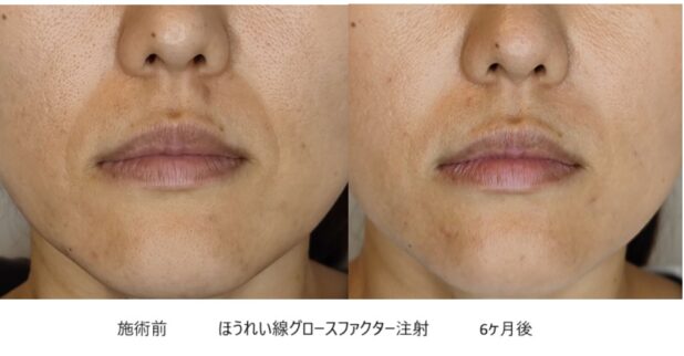 40代女性 症例27のほうれい線治療写真