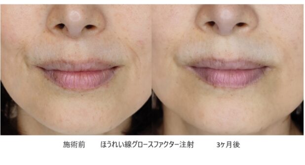 50代女性 症例30のほうれい線治療写真