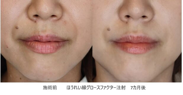 30代女性 症例24のほうれい線治療写真