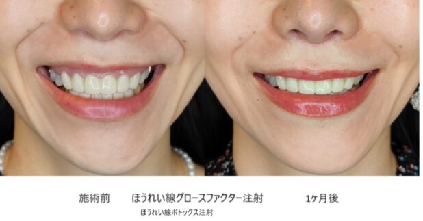 40代女性 症例20のほうれい線治療写真