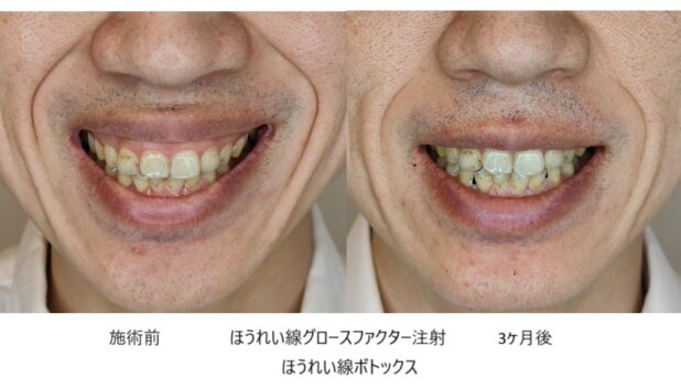 30代男性 症例6のほうれい線治療写真
