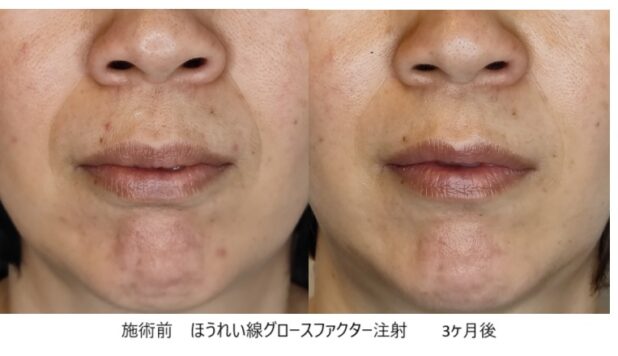 50代女性 症例27のほうれい線治療写真