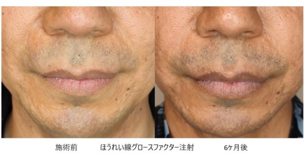 30代男性 症例5のほうれい線治療写真