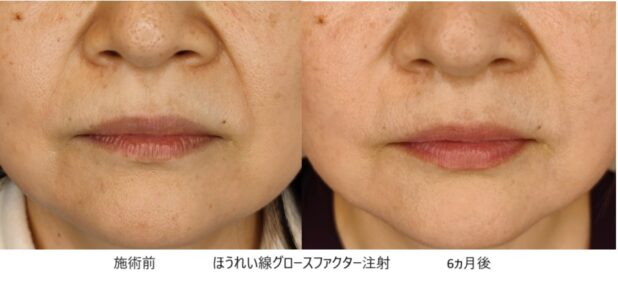50代女性 症例29のほうれい線治療写真