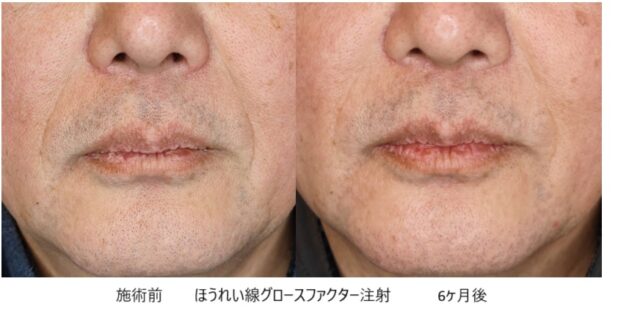 50代男性 症例4のほうれい線治療写真