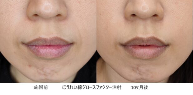 30代女性 症例25のほうれい線治療写真
