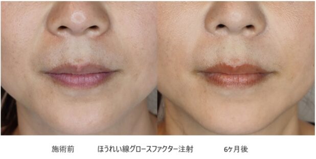 40代女性 症例26のほうれい線治療写真