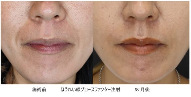 40代女性 症例22のほうれい線治療写真