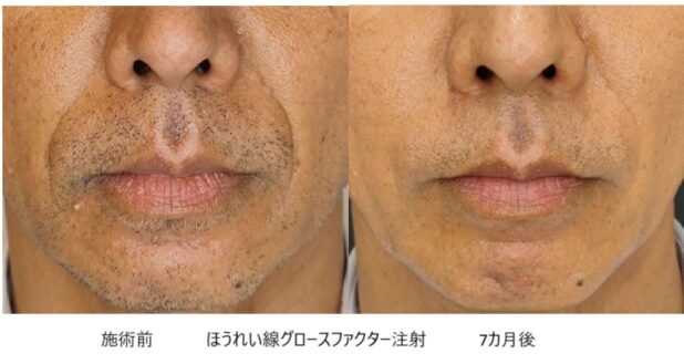 50代男性 症例3のほうれい線治療写真
