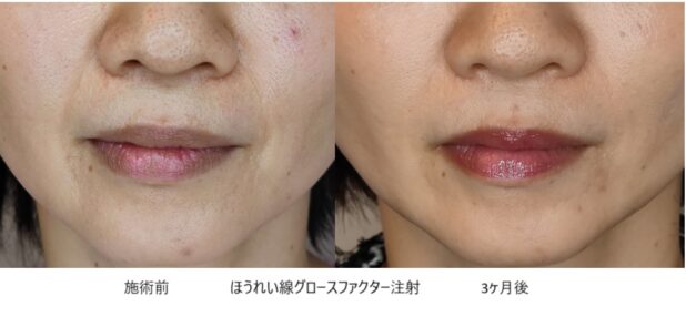 40代女性 症例24のほうれい線治療写真