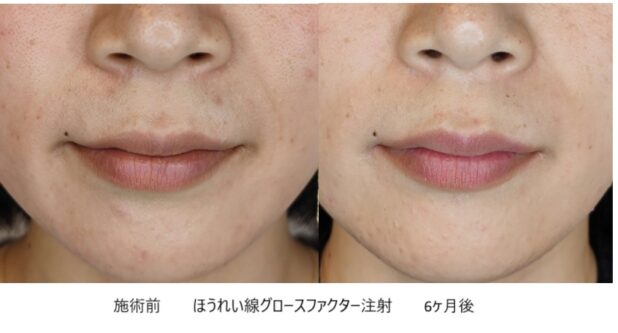 30代女性 症例26のほうれい線治療写真