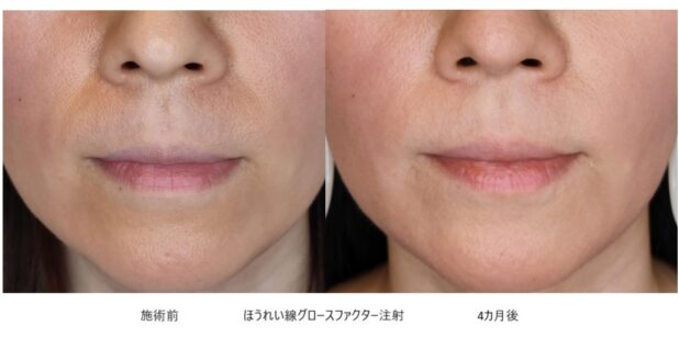 40代女性 症例29のほうれい線治療写真
