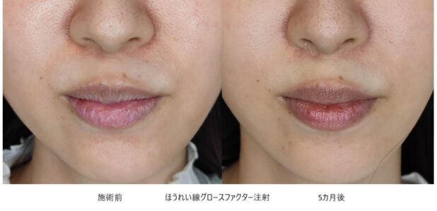 30代女性 症例30のほうれい線治療写真