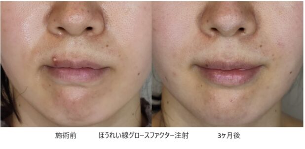 30代女性 症例27のほうれい線治療写真