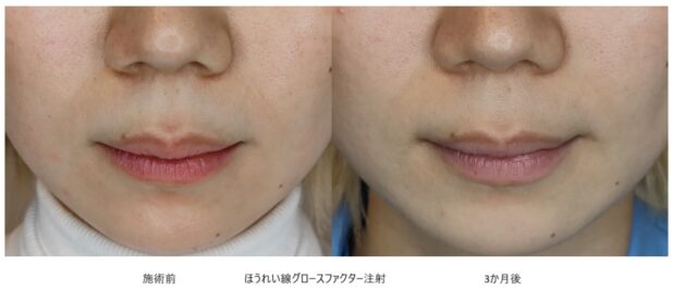20代女性 症例9のほうれい線治療写真