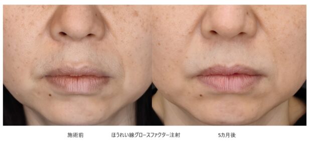 40代女性 症例30のほうれい線治療写真
