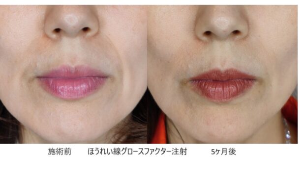 50代女性 症例33のほうれい線治療写真