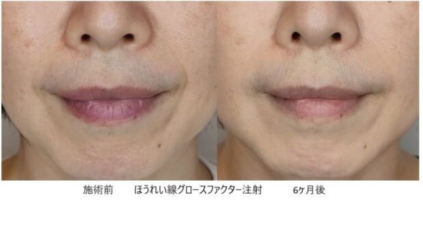 50代女性 症例32のほうれい線治療写真