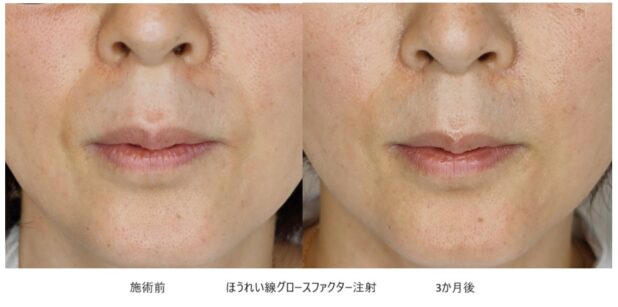 40代女性 症例28のほうれい線治療写真