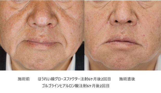 60代男性 症例3のほうれい線治療写真